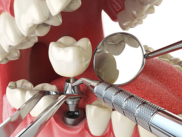 Best Urgent Tooth Repair  in Live Oak, CA